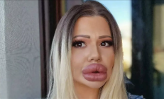 女子为拥有全球最大嘴唇花18万整形：看牙时惨遭医生拒绝